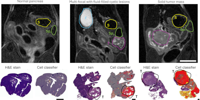 MRI pancreas analysis; H&E staining; tumor classification; pathology imaging; diagnostic process.