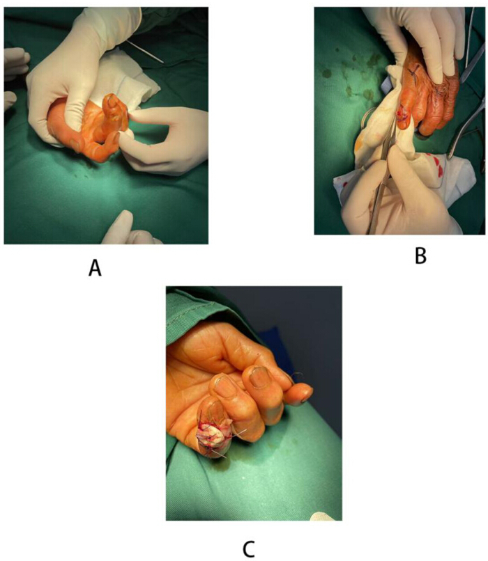 Surgical finger reconstruction process, gloved hands, wound closure, post-operative result.