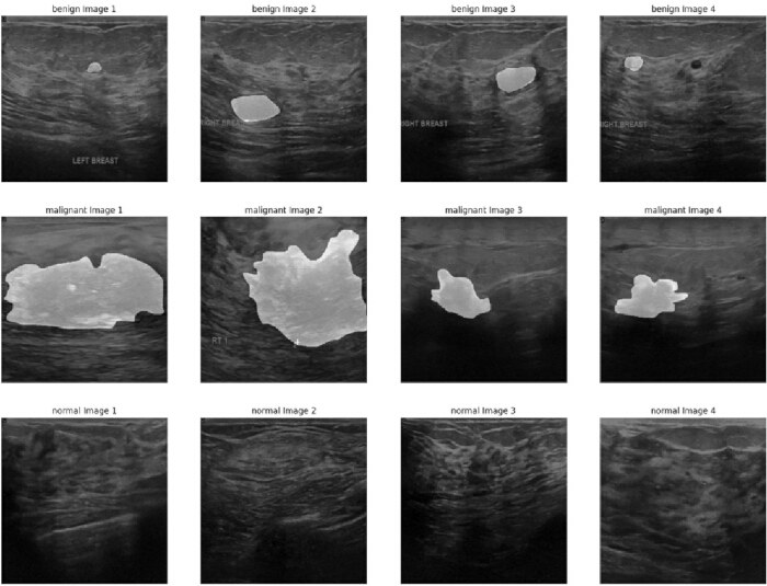 figure-protocol-1 Breast ultrasound images: benign, malignant, normal tissue comparison; cancer diagnosis, medical imaging.