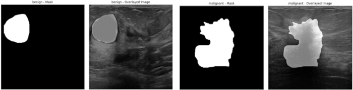 figure-protocol-5 Ultrasound segmentation results; benign and malignant tumor masks overlaid on ultrasound images.