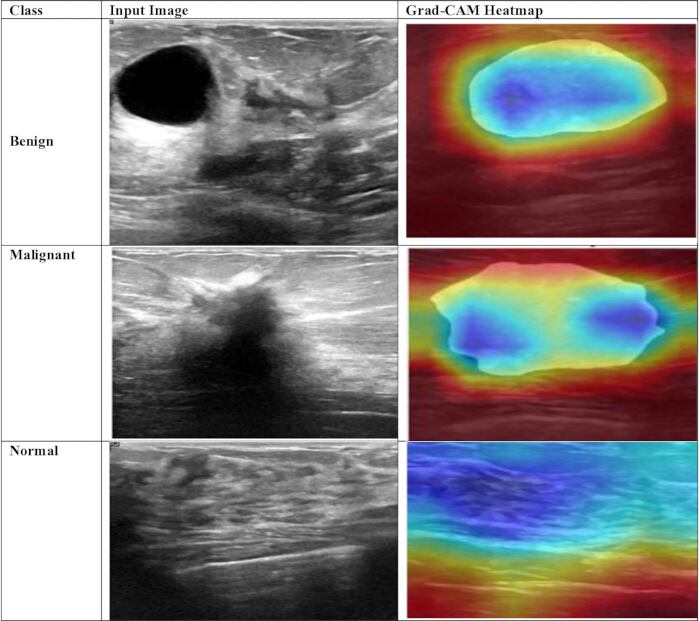 figure-protocol-22 Breast tumor classification using ultrasound and Grad-CAM heatmaps; benign, malignant, normal.