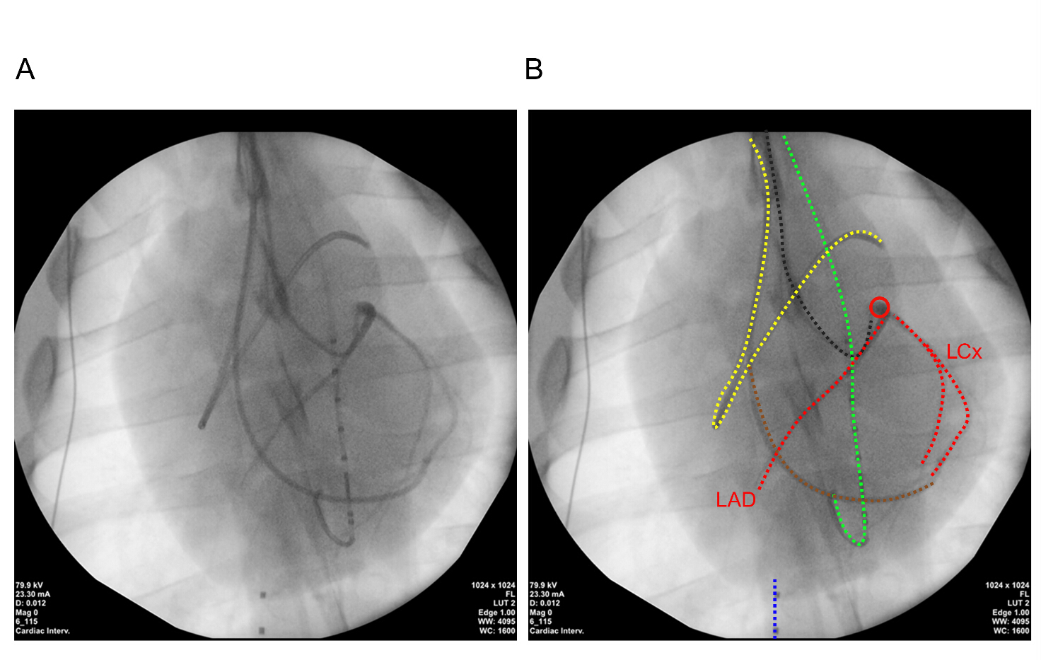 Fixed Volume-Intercept Approach for Serial Contractility Assessment ...