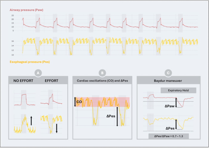 figure-protocol-1 Airway and esophageal pressure graph; cardiac oscillations, ΔPes, ΔPaw, Baydur maneuver diagram.