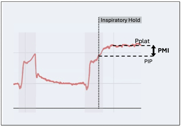 figure-protocol-2 Breathing dynamics graph; Pplat and PIP, PMI measurements, inspiratory hold, lung function chart.
