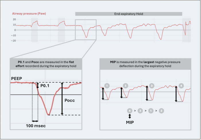 figure-protocol-3 Airway pressure analysis diagram; P0.1, Pocc, MIP measurements during expiratory hold; respiratory study.