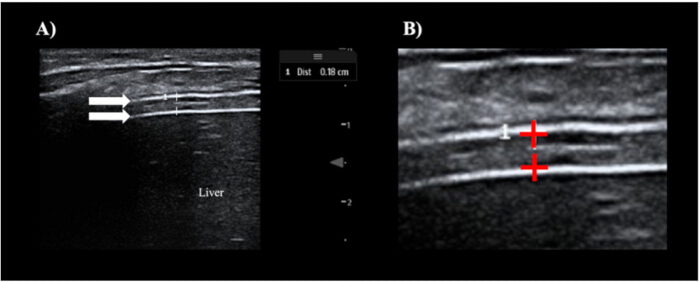 figure-protocol-4 Ultrasound imaging, liver assessment; diagram shows tissue layers with measurement indicators.