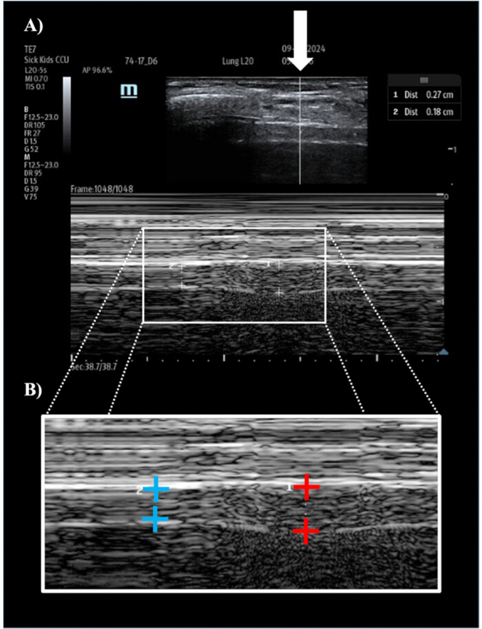 figure-protocol-5 Lung ultrasound image depicting tissue layers; used for medical analysis and diagnostic imaging.