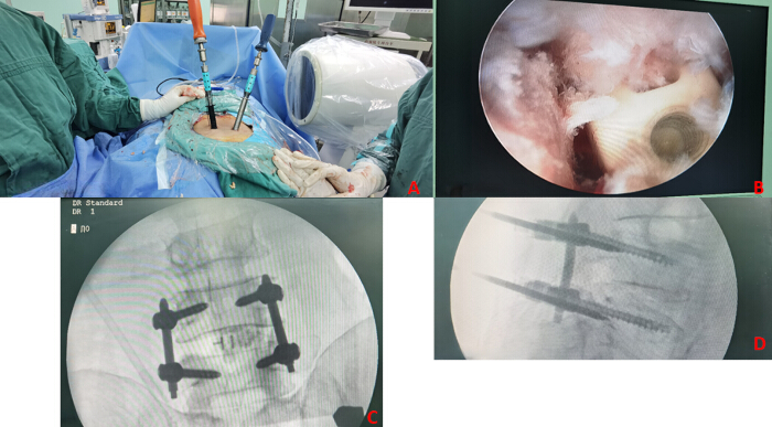 Minimally invasive spine surgery setup; endoscopic view; fluoroscopy images; spinal fixation.