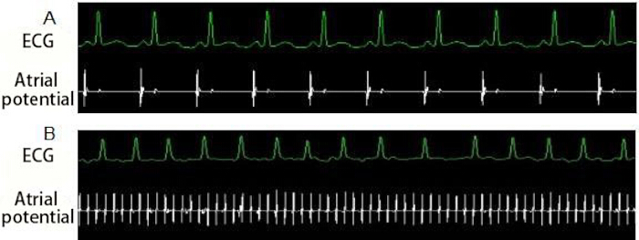figure-results-3 ECG and atrial potential graphs; cardiac electrophysiology analysis; heart rhythm comparison.
