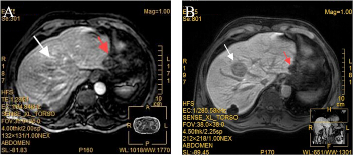 MRI liver scans comparison; annotated arrows; diagnostic imaging analysis.