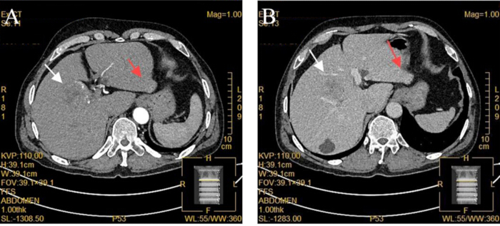 CT scan showing liver imaging with arrows indicating potential abnormalities; diagnostic analysis.