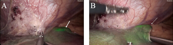 Laparoscopic view of bile duct identification; fluorescence imaging technique for surgical guidance.