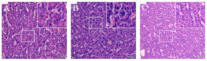 Histopathology slides showing liver tissue changes, high magnification, microscopy analysis.