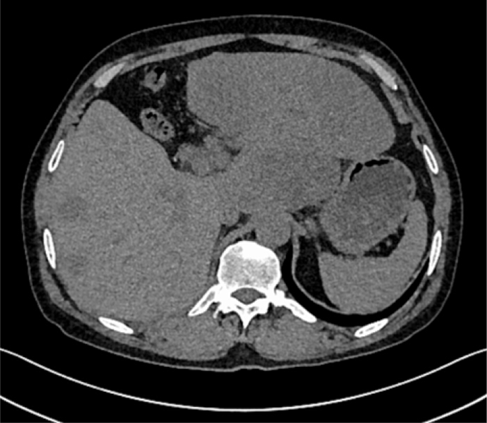 CT scan image showing abdominal cross-section; medical imaging analysis.