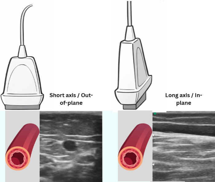 Ultrasound probe orientation diagram: short axis vs. long axis approach in vascular imaging.