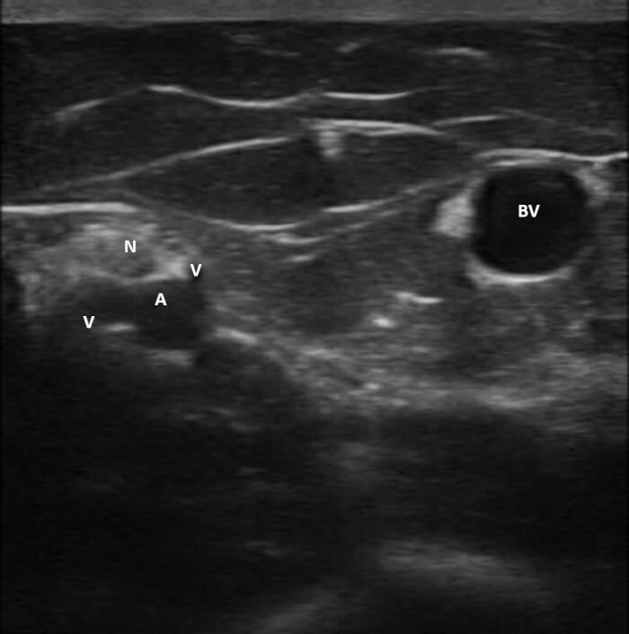 Ultrasound nerve block diagram, showing nerve, artery, vein (N, A, V), and blood vessel (BV).