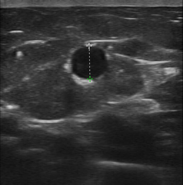 Ultrasound image; medical imaging; transverse view of lesion; diagnostic assessment; healthcare.