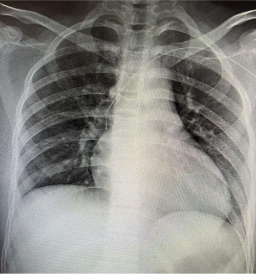 Chest X-ray showing lung structure, rib cage; medical diagnostic imaging for clinical assessment.