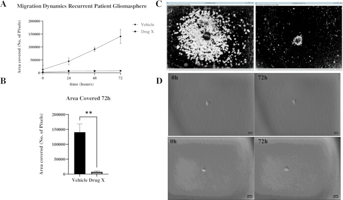 Gliomasphere migration analysis: graph, bar chart, microscopy images, drug effect on tumor cell movement.