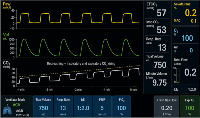 figure-results-2 Ventilation monitoring: pressure, volume, and CO₂ waveform chart; VCV mode analysis in respiratory care.