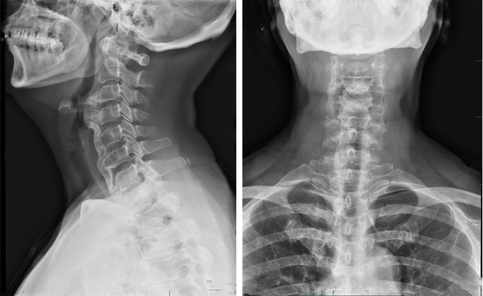 X-ray imaging; cervical spine and neck; lateral and frontal views; diagnostic radiology.