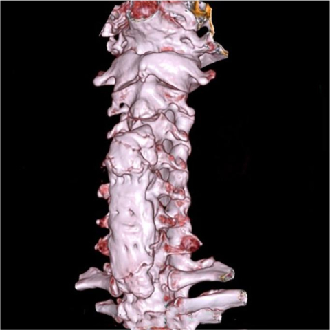 CT scan of cervical spine, 3D reconstruction, anatomical structure, vertebrae alignment analysis.