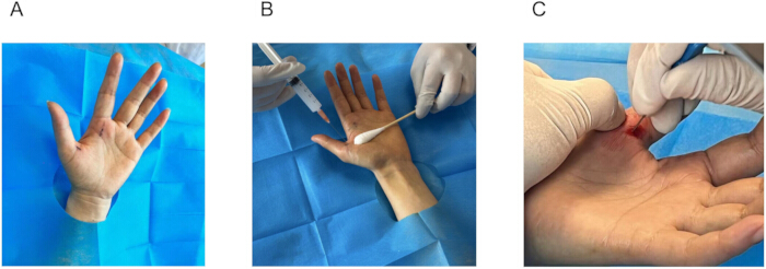 figure-protocol-2 Hand surgery preparation showing antiseptic application and incision process.