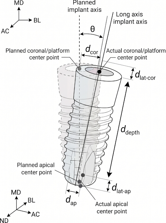 figure-protocol-8 Dental implant alignment diagram; planned vs. actual axis, coronal/apical center points, θ angle.
