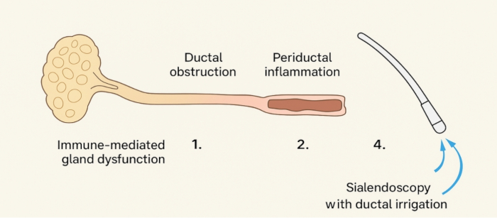 figure-protocol-1 Salivary gland dysfunction process; diagram showing ductal obstruction and sialendoscopy steps.