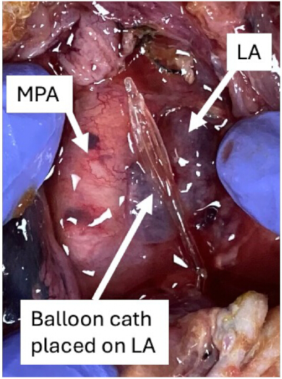 figure-results-3 Surgical image of balloon catheter placement on LA for medical procedure study.
