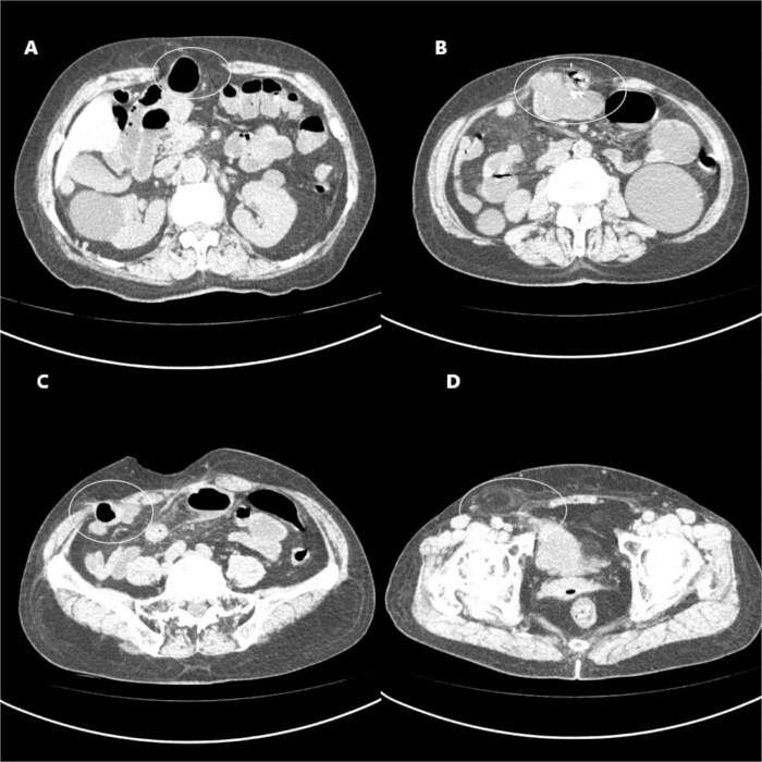 CT scan images, axial views; abdominal cross-sections, diagnostic analysis, radiology examination.