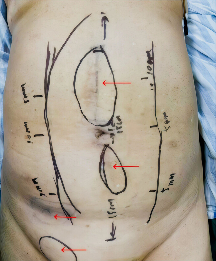 Surgical planning diagram with marked incision sites for abdominal procedure.