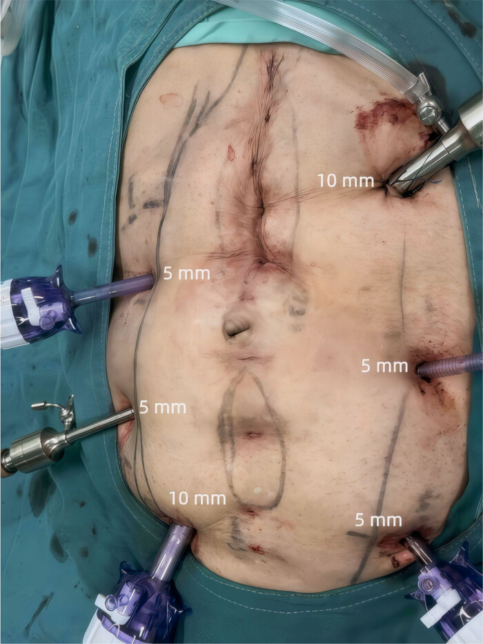 Laparoscopic incisions in surgery setup with trocar placement for minimally invasive procedure.