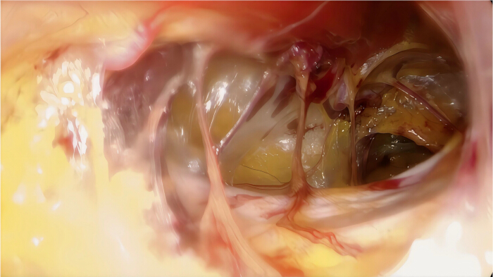 Internal view of heart showing chordae tendineae; anatomy diagram useful for medical education.