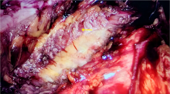 Surgical technique, thoracic cavity tissue dissection, labeled step, medical procedure, anatomy.