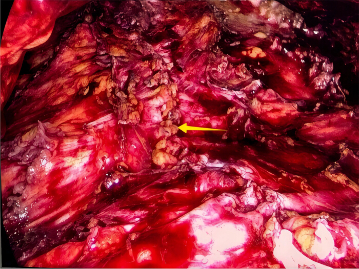 Surgical procedure image with arrow indicating tissue area, important for medical study analysis.