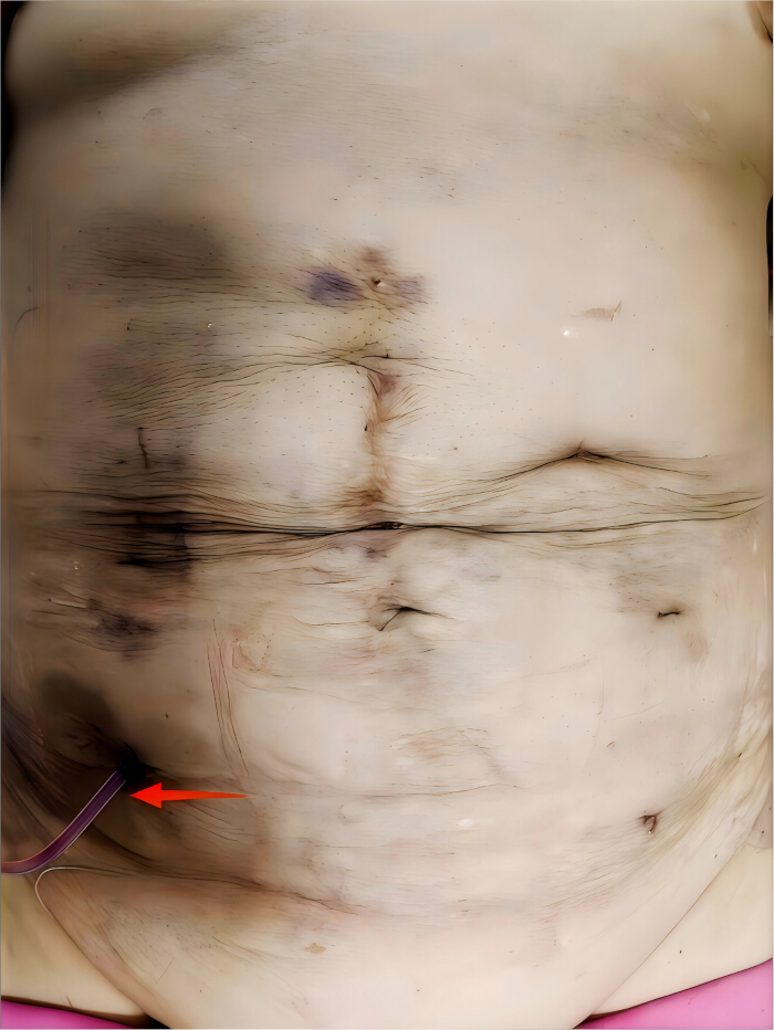 Abdominal anatomy; catheter insertion site.