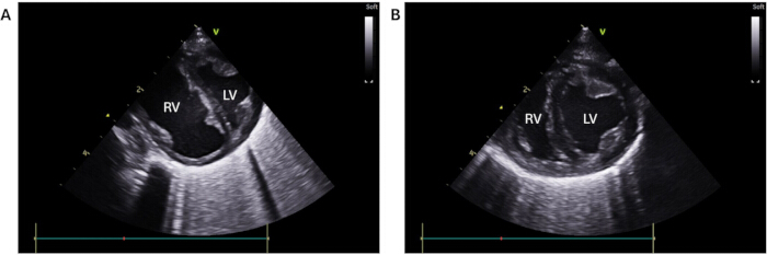 Cardiac ultrasound showing RV and LV in echocardiogram; diagnostic imaging, heart structure.