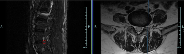 MRI scans, lumbar spine analysis, axial and sagittal views, diagnostic imaging, spinal structure evaluation.