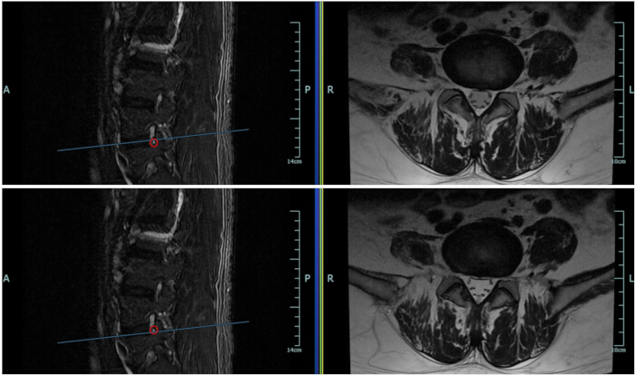 MRI lumbar spine scan showing sagittal and axial views; diagnostic imaging, lumbar alignment.