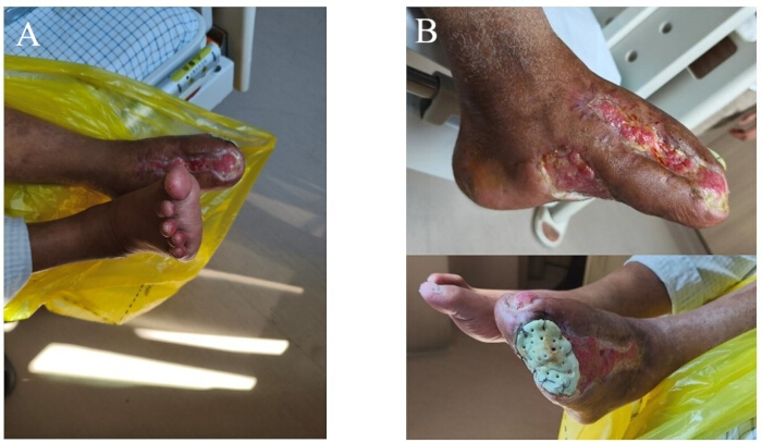 Diabetic foot ulcers treatment and healing comparison, medical image, wound care study.