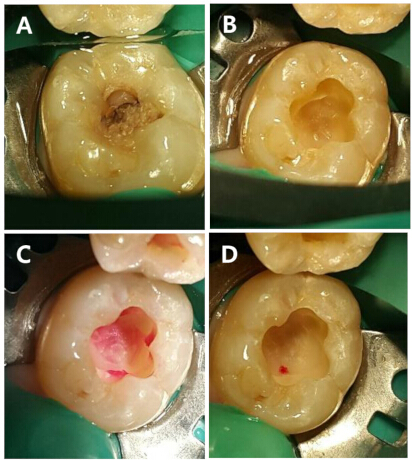 Assessment-Based Pulp And Dentin Removal Protocols For Vital Pulp