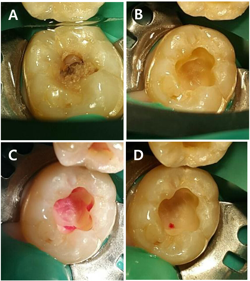 Assessment-Based Pulp And Dentin Removal Protocols For Vital Pulp