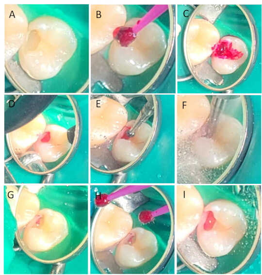 Dental restoration process; nine-panel diagram showing cavity treatment and filling application.