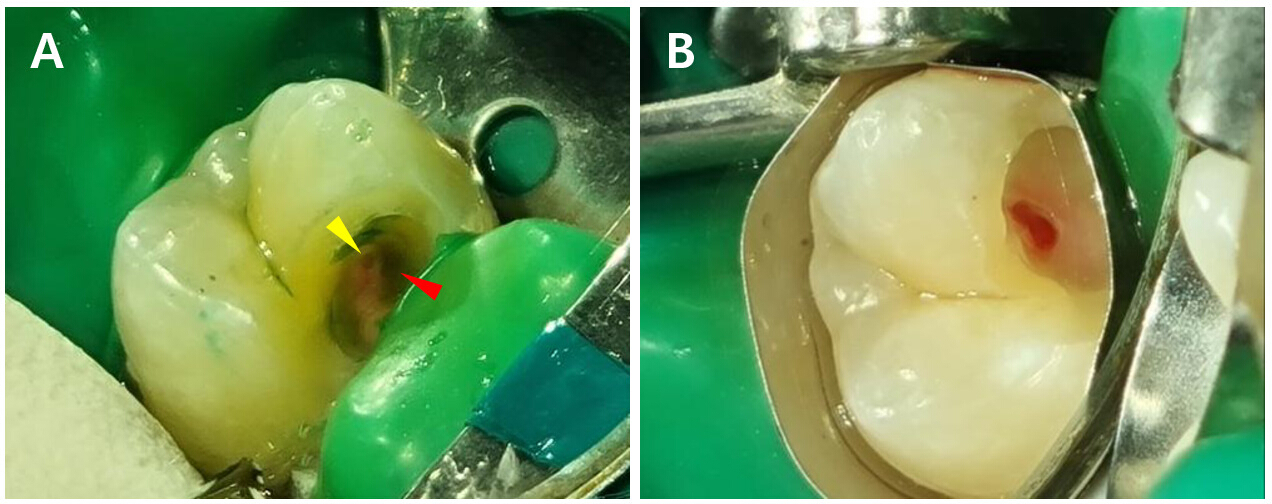 Assessment-Based Pulp And Dentin Removal Protocols For Vital Pulp