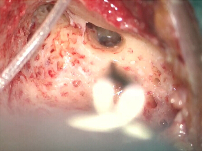 Surgical view of cranial topology, displaying bone and tissue structures in medical procedure.