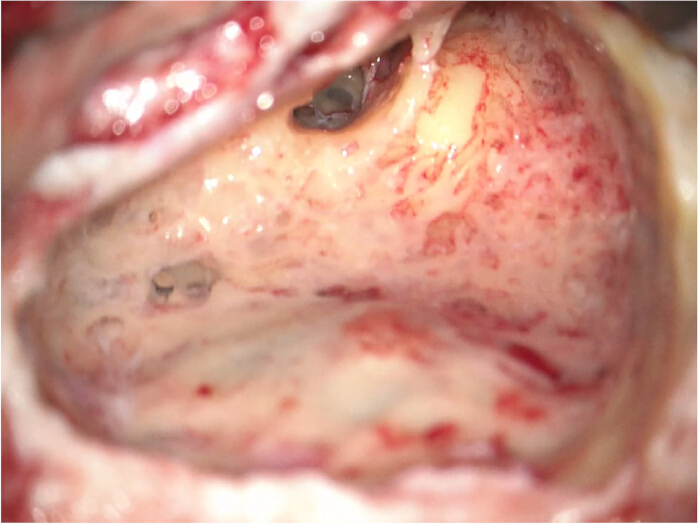 Endoscopic view, sinus cavity; inflammation observed. Medical examination for sinusitis diagnosis.