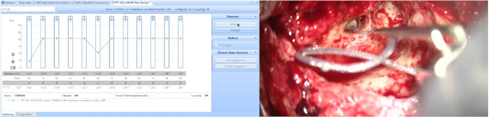 Surgery technique with feedback graph; telemetry system; data on nerve response during procedure.