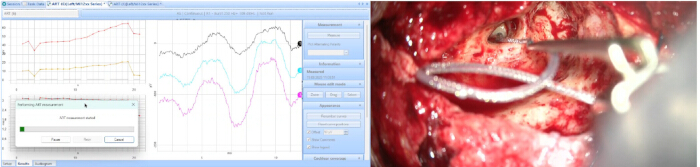 Neurosurgery procedure with intraoperative nerve monitoring; includes signal graph, surgical view.