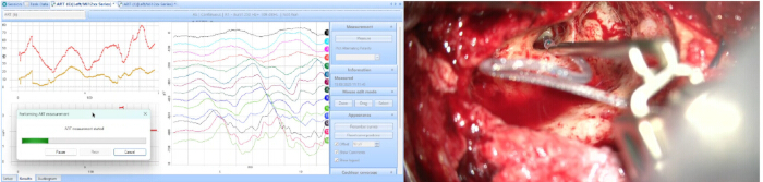 Surgical monitoring process; EEG data analysis chart and surgical equipment in use.